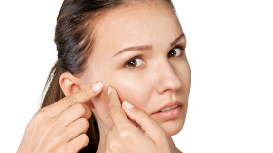 How to Prevent and Treat Acne?